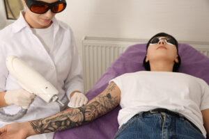 Tattoo Removal